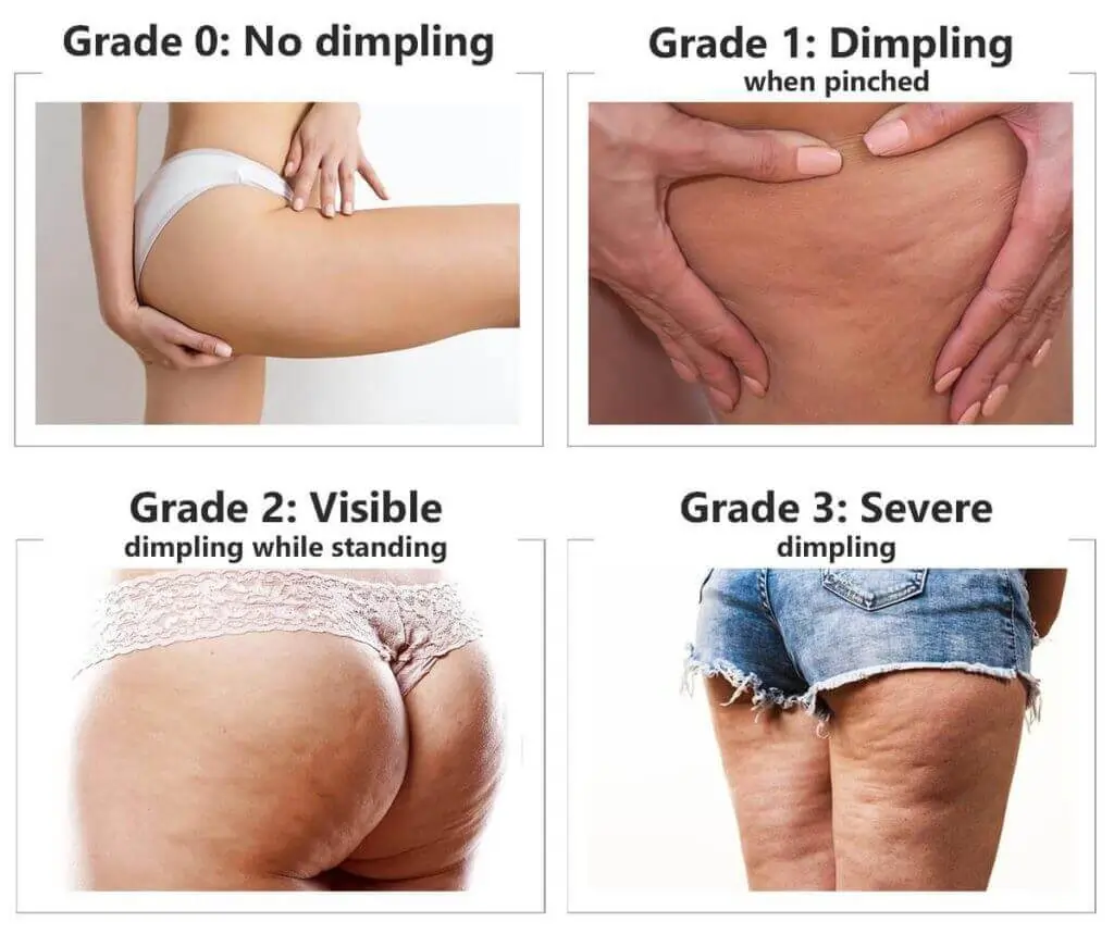 Representation of the stages of cellulite development Arundel